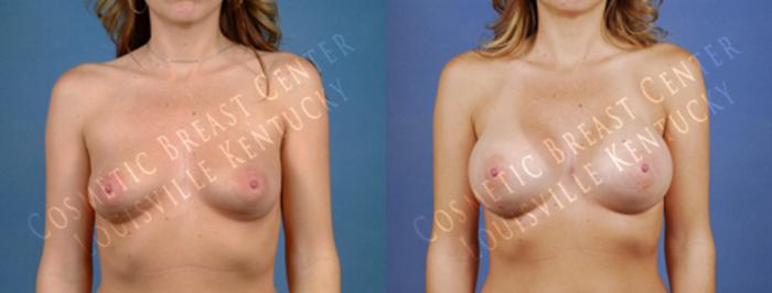 Before & After Enlargement - Saline Case 182 View #1 View in Louisville & Lexington, KY