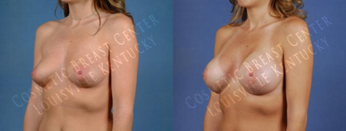 Before & After Enlargement - Saline Case 182 View #2 View in Louisville & Lexington, KY