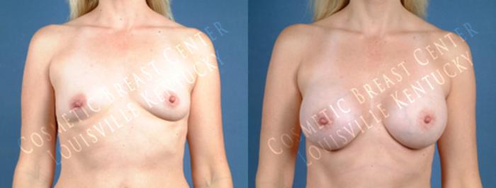 Before & After Enlargement - Saline Case 183 View #1 View in Louisville & Lexington, KY