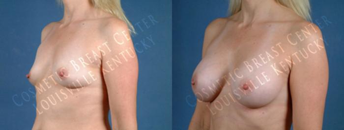 Before & After Enlargement - Saline Case 183 View #2 View in Louisville & Lexington, KY