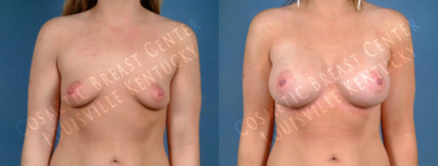 Before & After Enlargement - Saline Case 184 View #1 View in Louisville & Lexington, KY