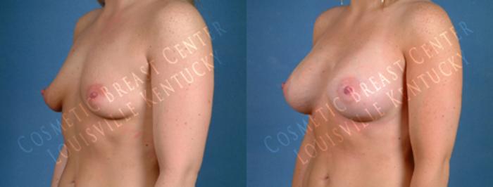 Before & After Enlargement - Saline Case 184 View #2 View in Louisville & Lexington, KY