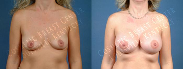 Before & After Enlargement - Saline Case 185 View #1 View in Louisville & Lexington, KY