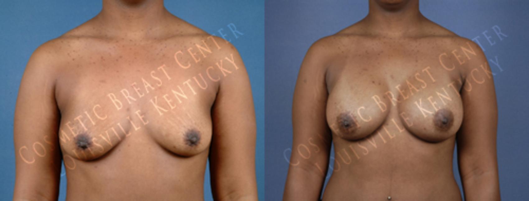 Before & After Enlargement - Saline Case 186 View #1 View in Louisville & Lexington, KY
