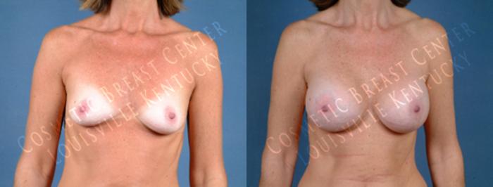 Before & After Enlargement - Saline Case 187 View #1 View in Louisville & Lexington, KY
