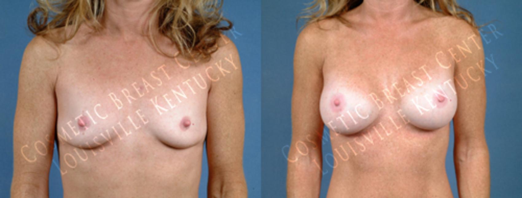 Before & After Enlargement - Saline Case 188 View #1 View in Louisville & Lexington, KY