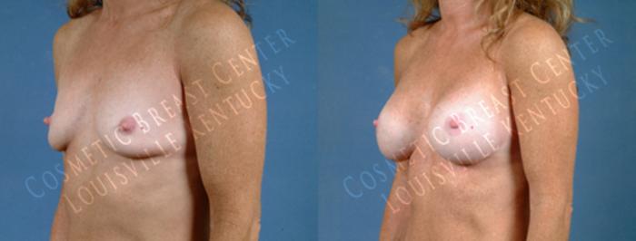 Before & After Enlargement - Saline Case 188 View #2 View in Louisville & Lexington, KY