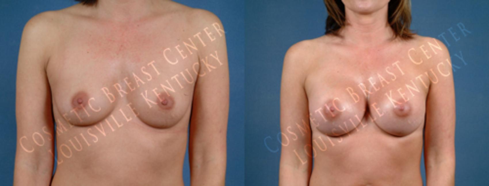 Before & After Enlargement - Saline Case 189 View #1 View in Louisville & Lexington, KY