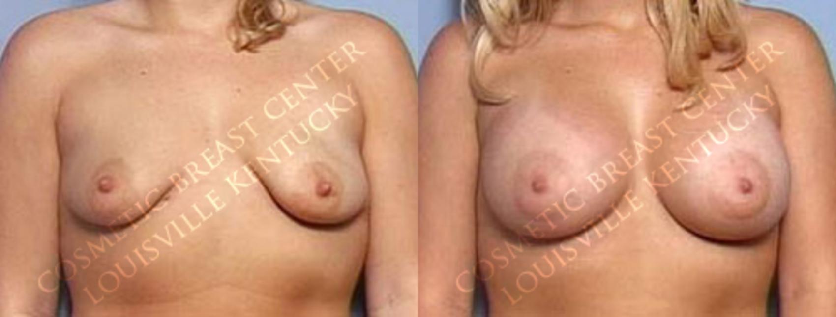 Before & After Enlargement - Saline Case 19 View #1 View in Louisville & Lexington, KY