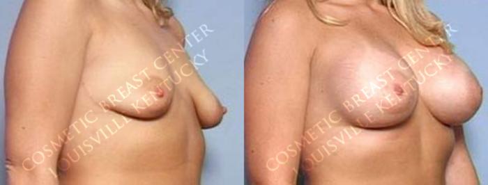 Before & After Enlargement - Saline Case 19 View #2 View in Louisville & Lexington, KY