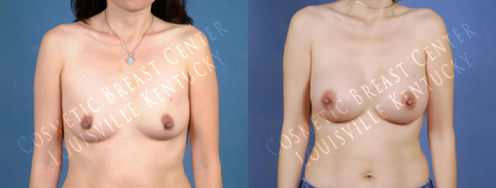 Before & After Enlargement - Saline Case 190 View #1 View in Louisville & Lexington, KY