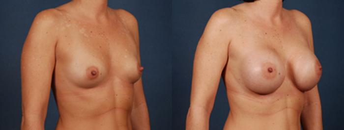 Before & After Enlargement - Saline Case 191 View #2 View in Louisville & Lexington, KY