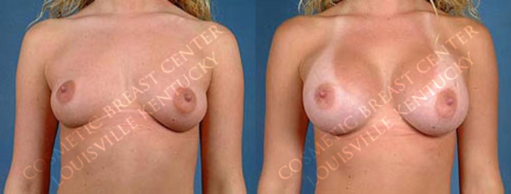 Before & After Enlargement - Saline Case 2 View #1 View in Louisville & Lexington, KY