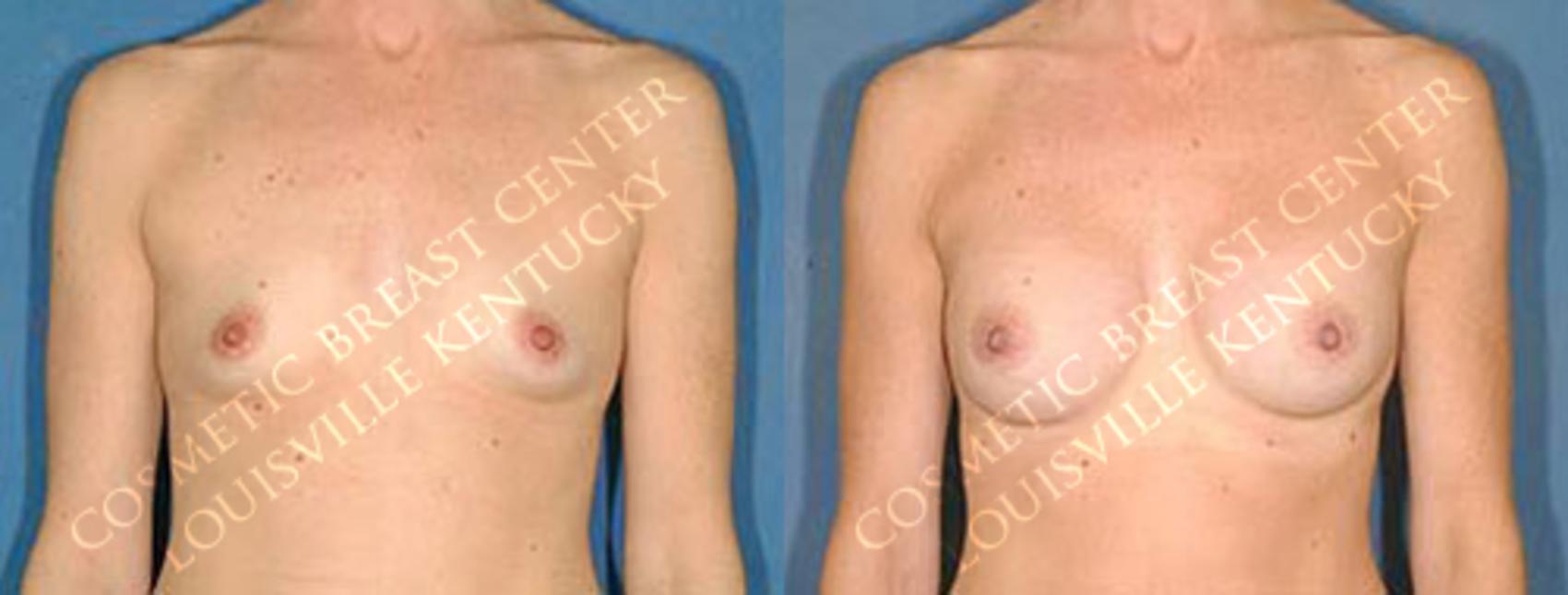 Before & After Enlargement - Saline Case 20 View #1 View in Louisville & Lexington, KY