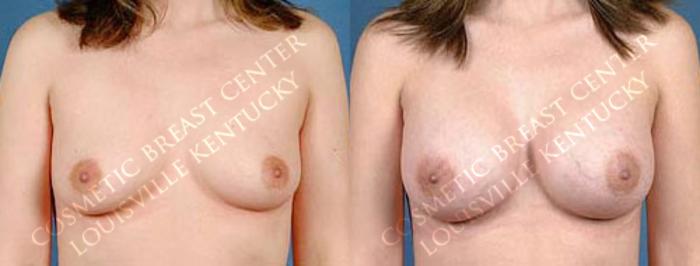 Before & After Enlargement - Saline Case 21 View #1 View in Louisville & Lexington, KY