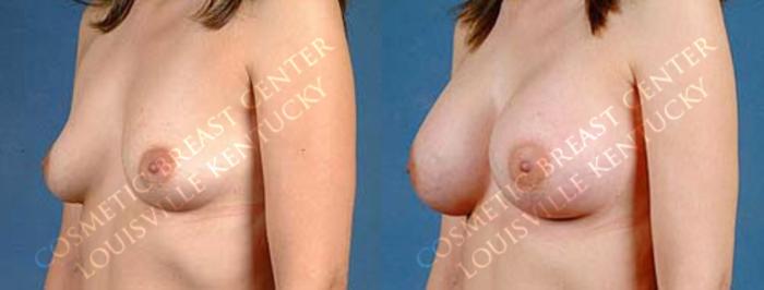 Before & After Enlargement - Saline Case 21 View #2 View in Louisville & Lexington, KY
