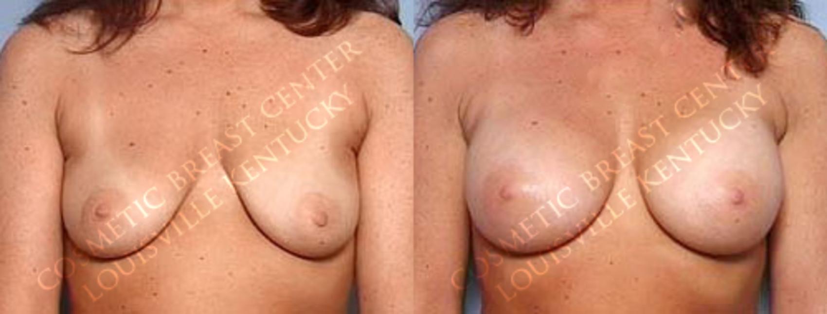 Before & After Enlargement - Saline Case 22 View #1 View in Louisville & Lexington, KY