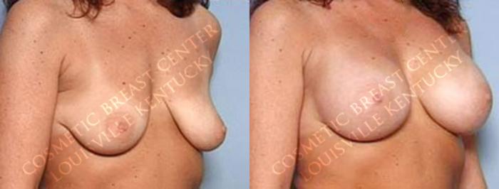 Before & After Enlargement - Saline Case 22 View #2 View in Louisville & Lexington, KY