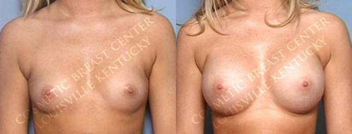 Before & After Enlargement - Saline Case 23 View #1 View in Louisville & Lexington, KY