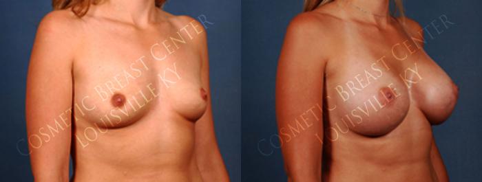 Before & After Enlargement - Saline Case 230 View #2 View in Louisville & Lexington, KY