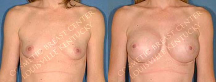 Before & After Enlargement - Saline Case 24 View #1 View in Louisville & Lexington, KY