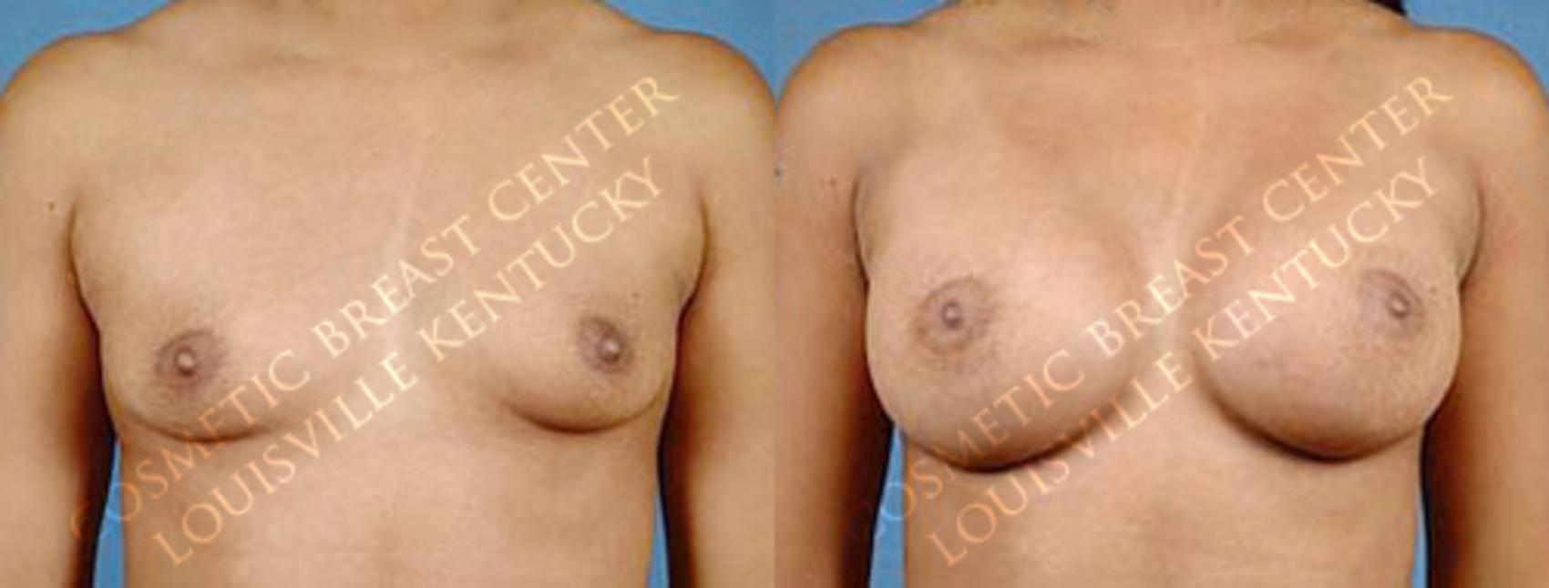 Before & After Enlargement - Saline Case 25 View #1 View in Louisville & Lexington, KY