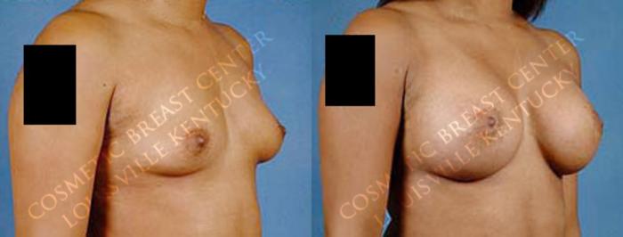 Before & After Enlargement - Saline Case 25 View #2 View in Louisville & Lexington, KY