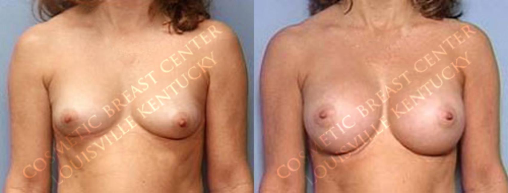Before & After Enlargement - Saline Case 26 View #1 View in Louisville & Lexington, KY