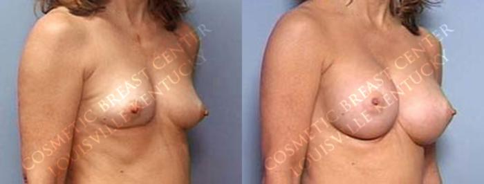 Before & After Enlargement - Saline Case 26 View #2 View in Louisville & Lexington, KY