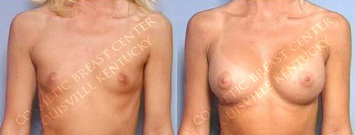 Before & After Enlargement - Saline Case 27 View #1 View in Louisville & Lexington, KY