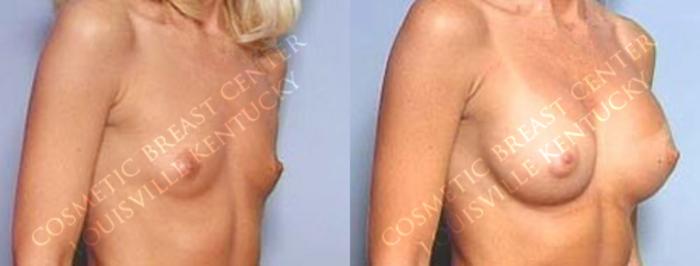 Before & After Enlargement - Saline Case 27 View #2 View in Louisville & Lexington, KY