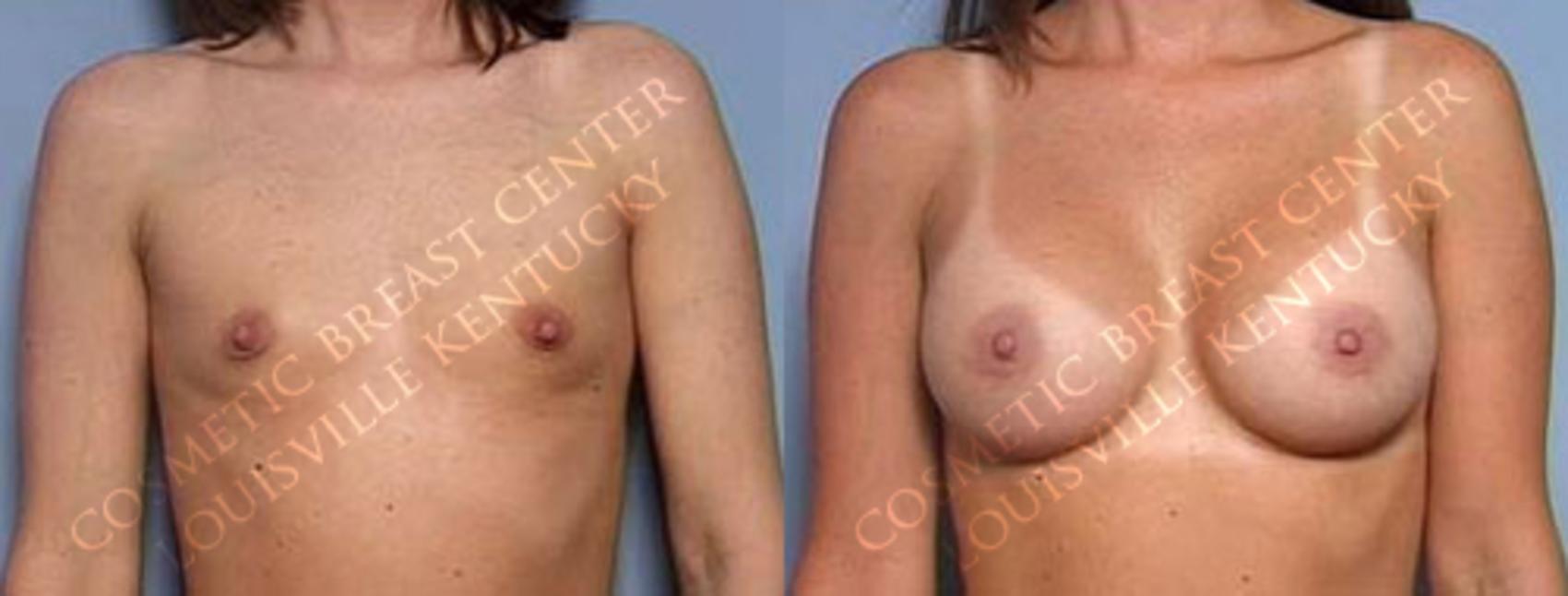Before & After Enlargement - Saline Case 28 View #1 View in Louisville & Lexington, KY