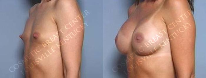 Before & After Enlargement - Saline Case 28 View #2 View in Louisville & Lexington, KY