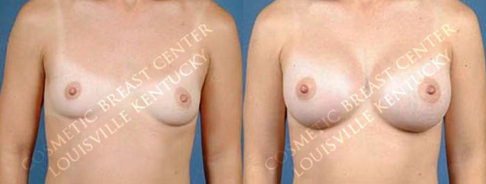Before & After Enlargement - Saline Case 3 View #1 View in Louisville & Lexington, KY