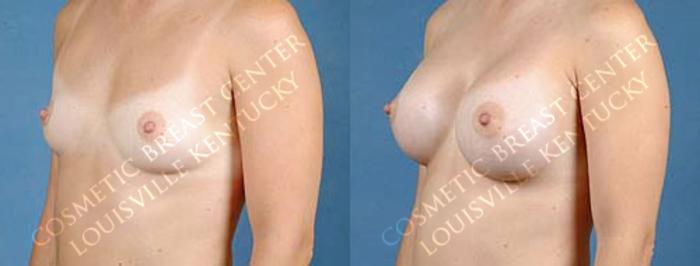 Before & After Enlargement - Saline Case 3 View #2 View in Louisville & Lexington, KY