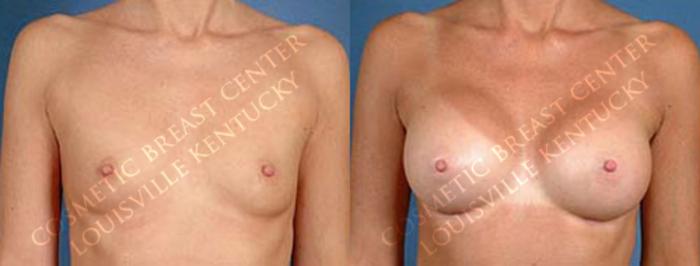 Before & After Enlargement - Saline Case 30 View #1 View in Louisville & Lexington, KY