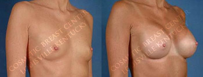 Before & After Enlargement - Saline Case 30 View #2 View in Louisville & Lexington, KY