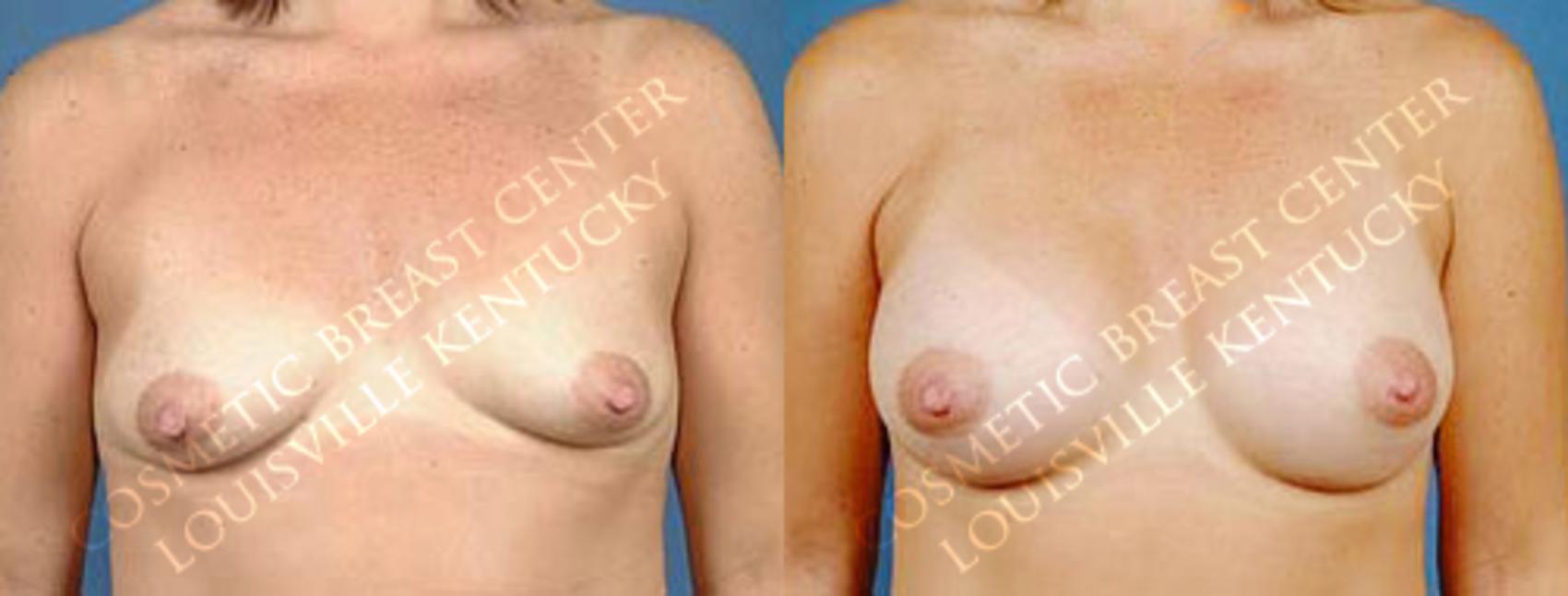 Before & After Enlargement - Saline Case 4 View #1 View in Louisville & Lexington, KY