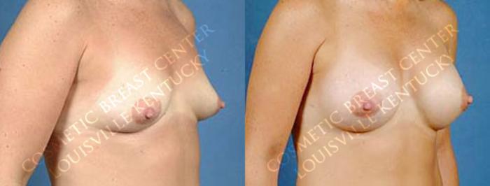 Before & After Enlargement - Saline Case 4 View #2 View in Louisville & Lexington, KY