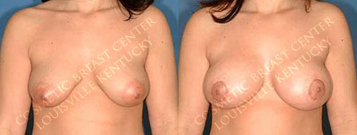 Before & After Enlargement - Saline Case 44 View #1 View in Louisville & Lexington, KY