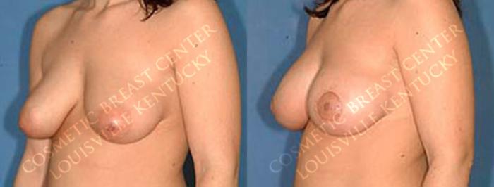 Before & After Enlargement - Saline Case 44 View #2 View in Louisville & Lexington, KY