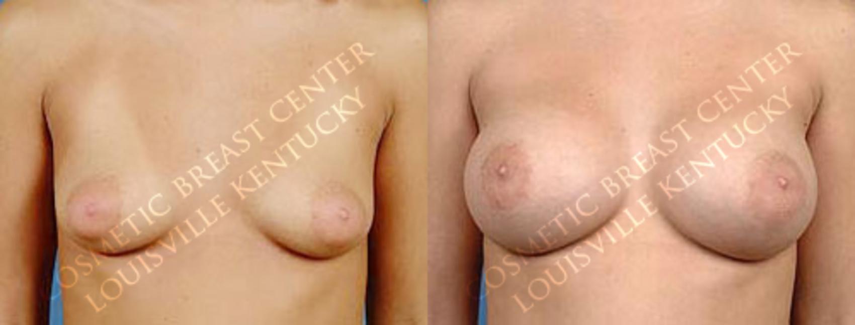 Before & After Enlargement - Saline Case 5 View #1 View in Louisville & Lexington, KY