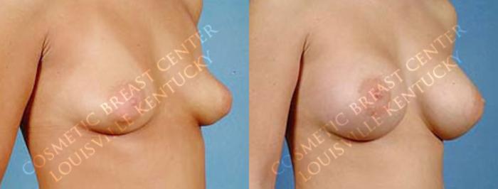 Before & After Enlargement - Saline Case 5 View #2 View in Louisville & Lexington, KY