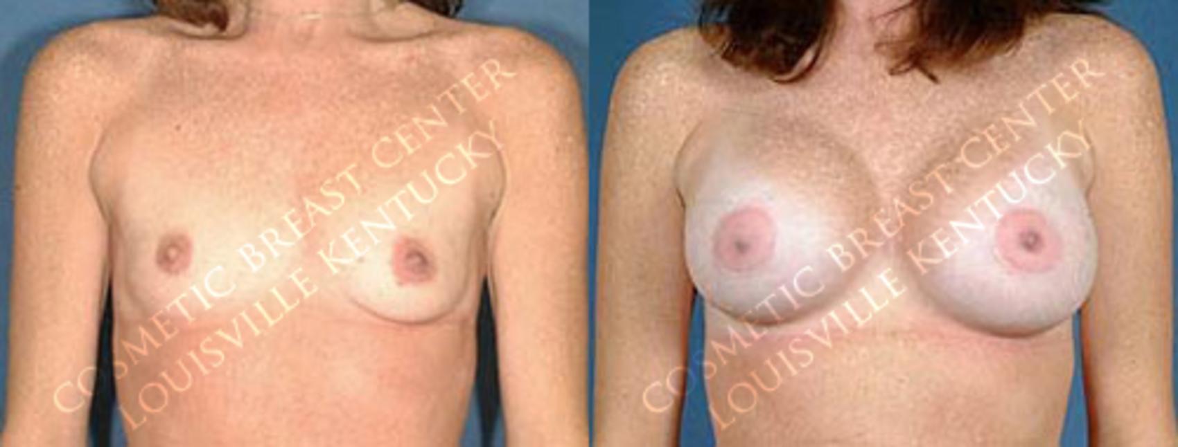 Before & After Enlargement - Saline Case 6 View #1 View in Louisville & Lexington, KY