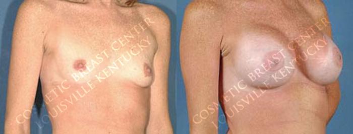 Before & After Enlargement - Saline Case 6 View #2 View in Louisville & Lexington, KY