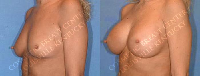 Before & After Enlargement - Saline Case 8 View #2 View in Louisville & Lexington, KY