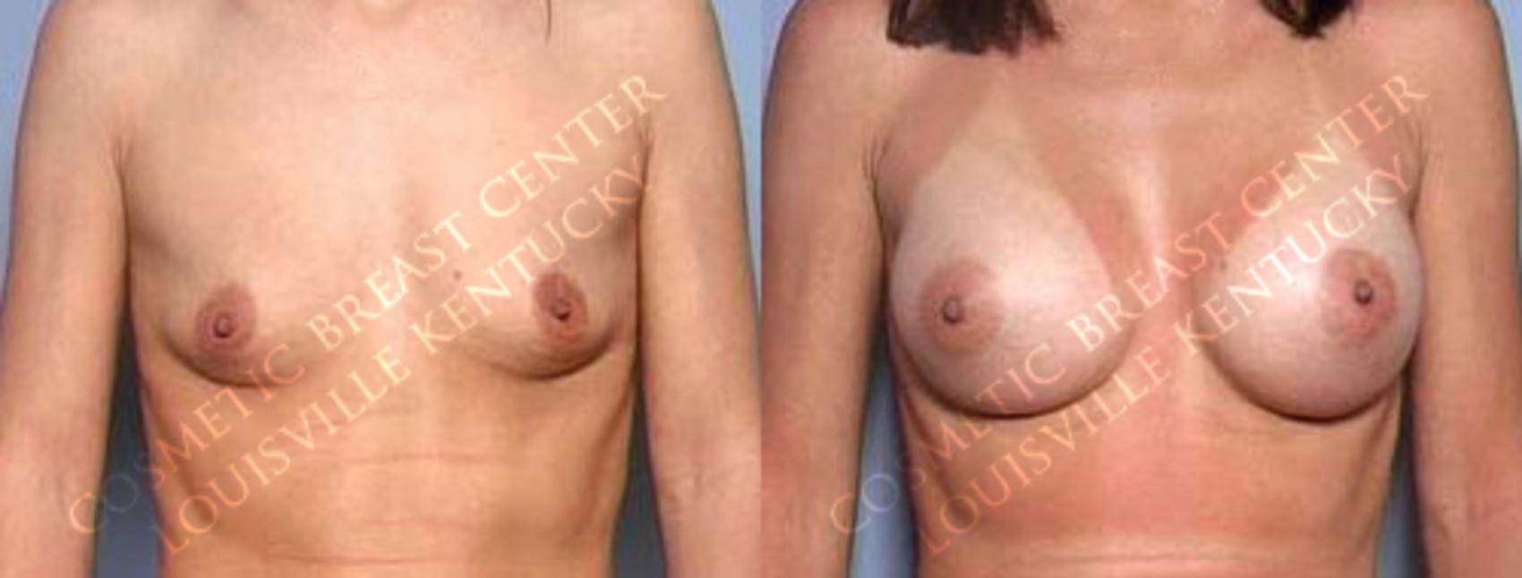 Before & After Enlargement - Saline Case 9 View #1 View in Louisville & Lexington, KY
