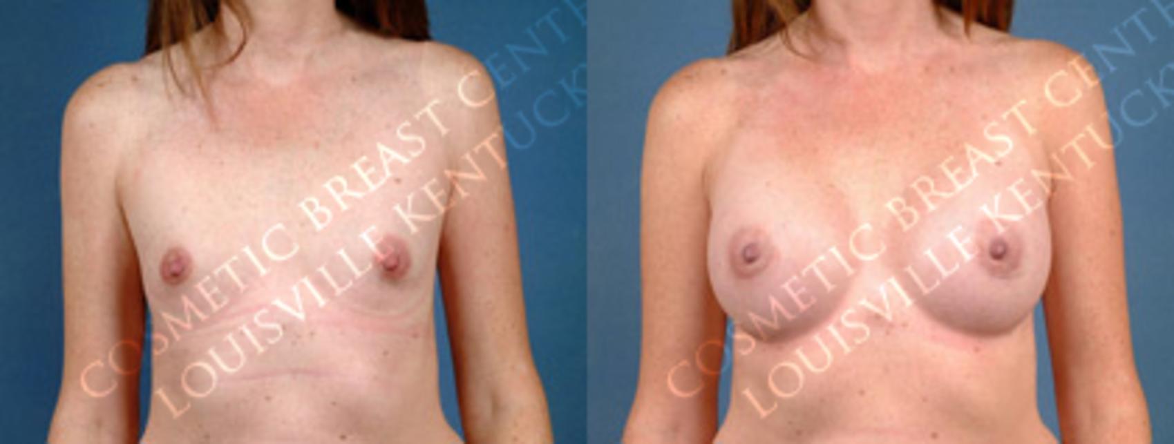 Before & After Enlargement - Silicone Case 155 View #1 View in Louisville & Lexington, KY
