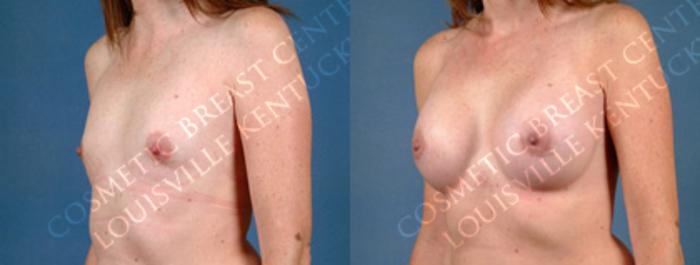 Before & After Enlargement - Silicone Case 155 View #2 View in Louisville & Lexington, KY