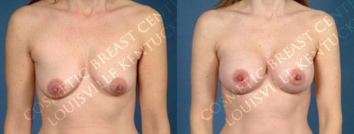Before & After Enlargement - Silicone Case 160 View #1 View in Louisville & Lexington, KY